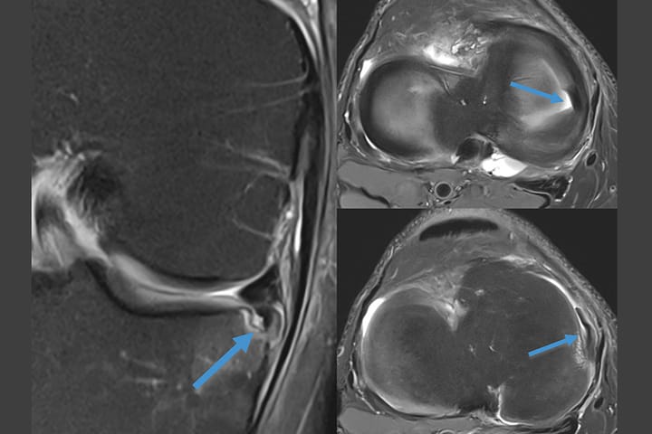 Fissure méniscale avec fragment méniscal déplacé
