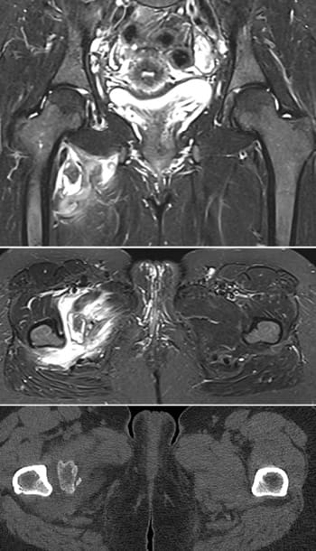 Myosite ossifiante circonscrite