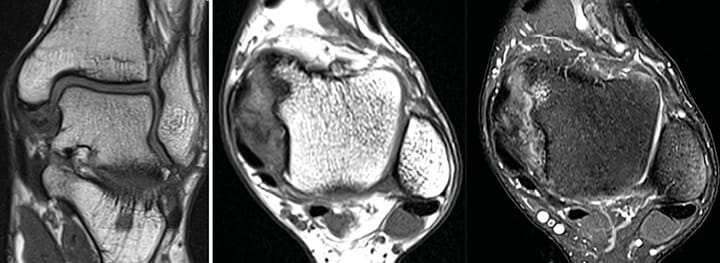 Conflit postéro-médial de la cheville
