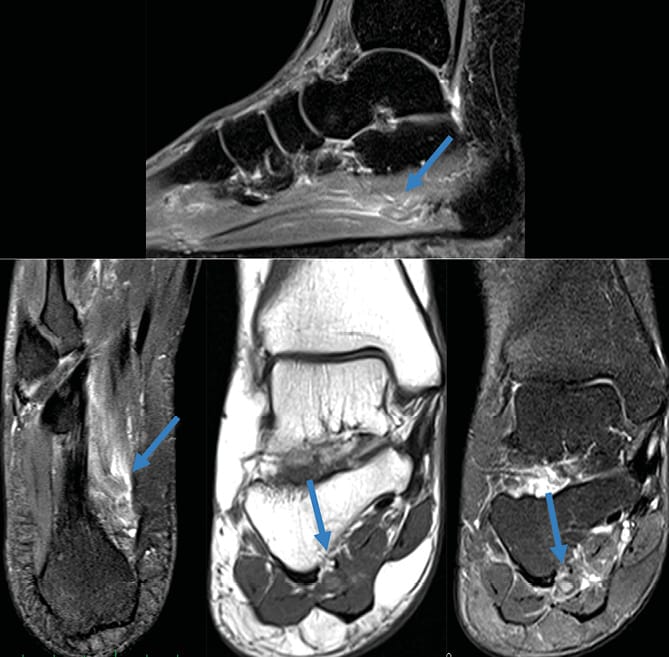 Thrombose de la veine plantaire latérale