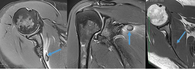 Dépôt de cristaux d'hydroxyapatite