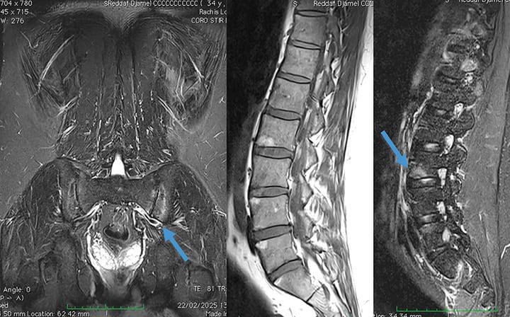 Spondylarthropathie/Spondylarthrite ankylosante
