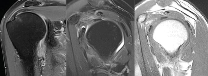 Capsulite rétractile