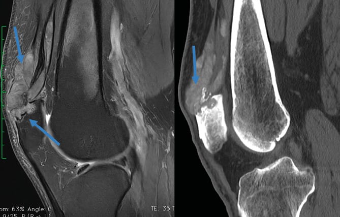 Tophus goutteux / hyperuricémie chronique