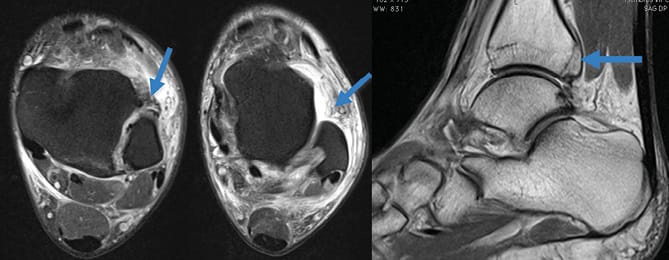 Entorse de la syndesmose tibio-fibulaire inférieure