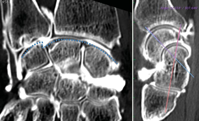 Rupture du ligament luno-triquétal et instabilité en VISI