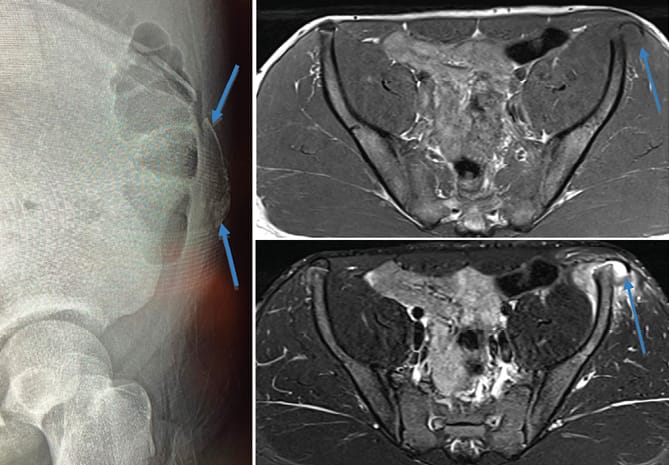 Désinsertion du noyau d'ossification de l'épine iliaque antéro-supérieure (EIAS)
