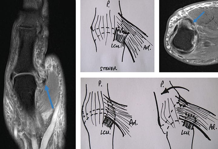 Rupture du ligament collatéral ulnaire de la MCP du pouce lésion de Stener