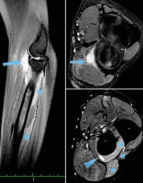 Compression de la branche motrice du nerf radial par une récidive postopératoire d'un kyste synovial de l'articulation huméro-radiale
