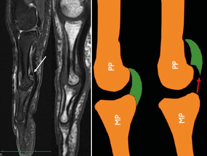 Rupture ancienne de la plaque palmaire de l'IPP