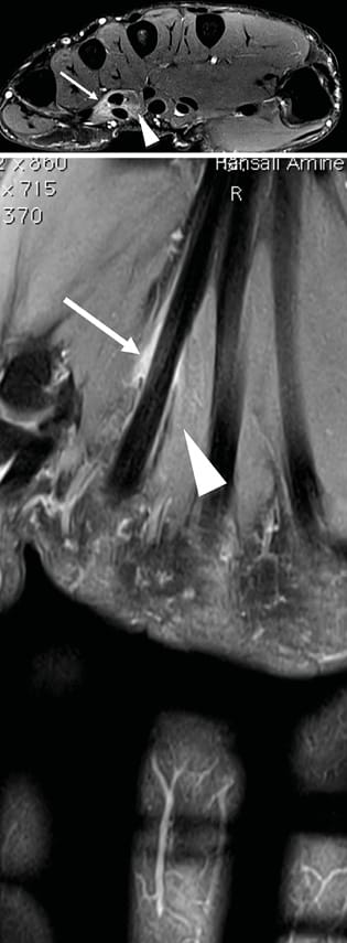 Lésion traumatique des muscles lombricaux