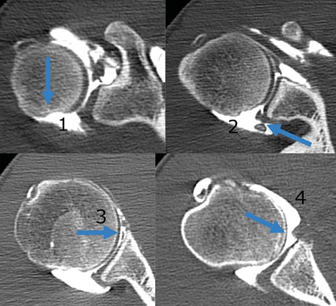 Instablilité antérieure de l'épaule