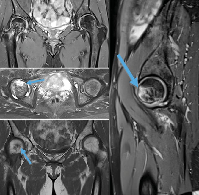 Fracture de fatigue de la tête fémorale