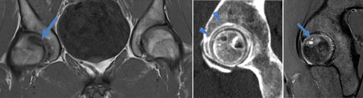 Lésion ostéo-chondrale post-traumatique de la tête fémorale
