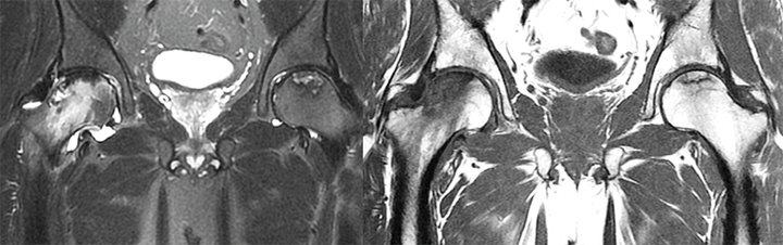 Ostéonécrose systémique de la tête fémorale