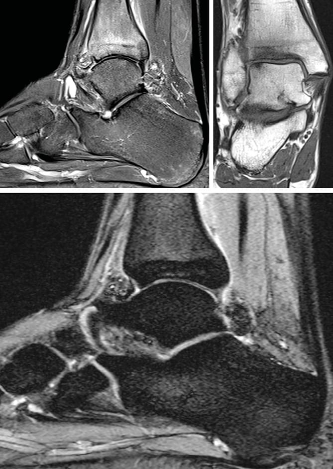 Arthropathie hémophilique