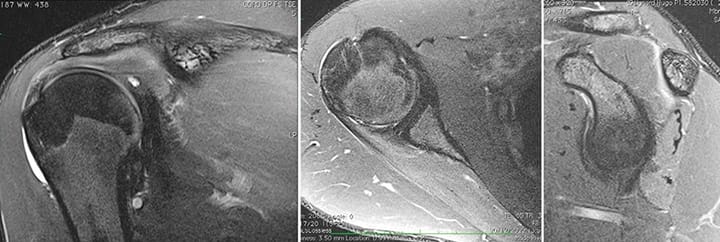 Le syndrome de Parsonage Turner