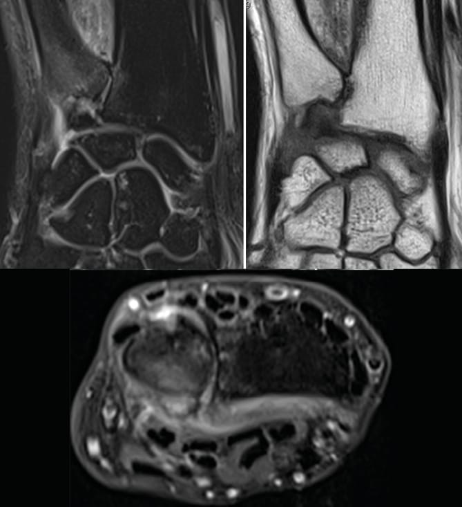 Conflit radio-ulnaire distal