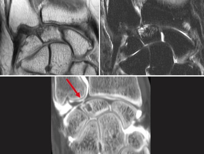 Conflit ulno-lunaire