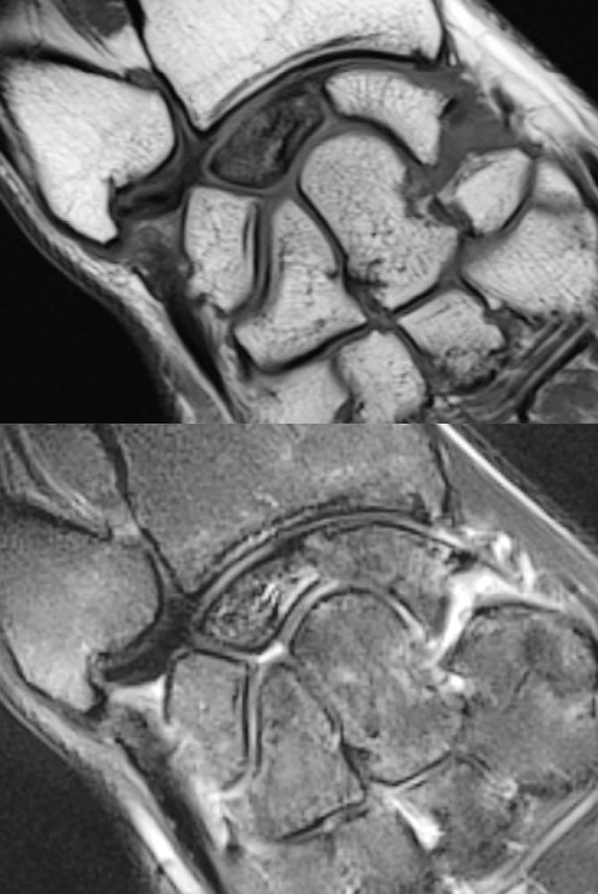 Maladie de Kienböck - nécrose du lunatum