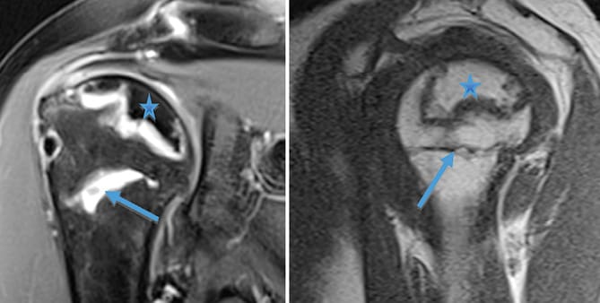 Ostéonécrose de la tête humérale secondaire à une fracture du col chirurgical