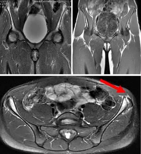 Apophysite et arrachement du noyau d'ossification de l'épine iliaque antéro-supérieure