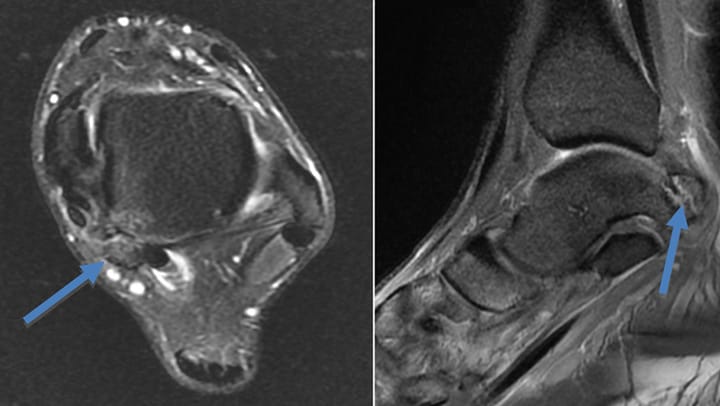 Syndrome du carrefour postérieur