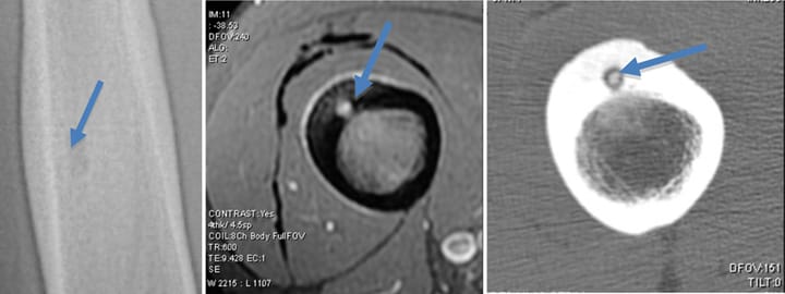 Ostéome ostéoïde du fémur
