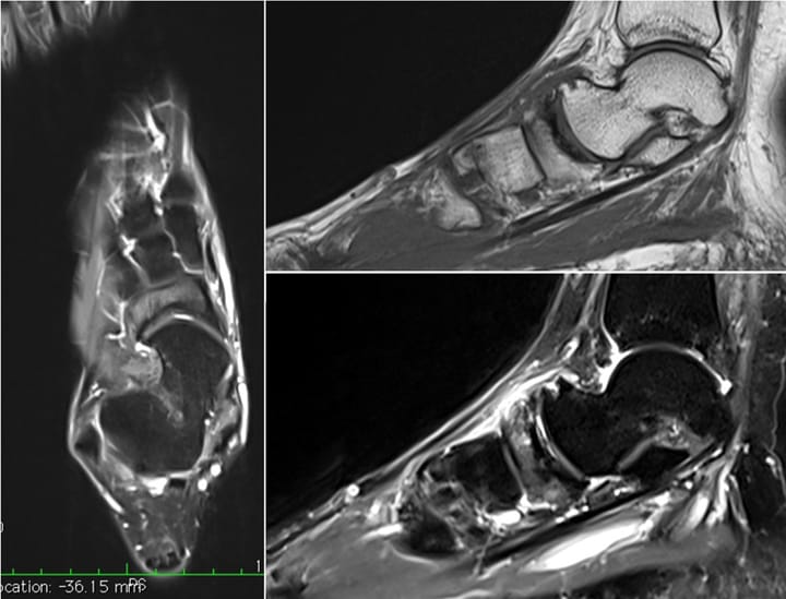 Maladie de Müller-Weiss ostéonécrose aseptique de l'os naviculaire