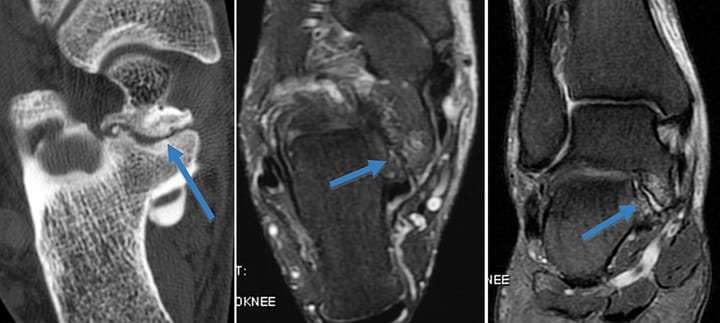 Synostose talo-calcanéenne