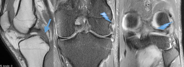 Rupture du ligament croisé postérieur et du ligament fibulaire collatéral