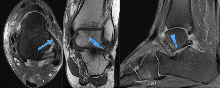Fracture du processus latéral du talus