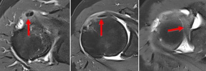 Luxation médiale de la longue portion du biceps
