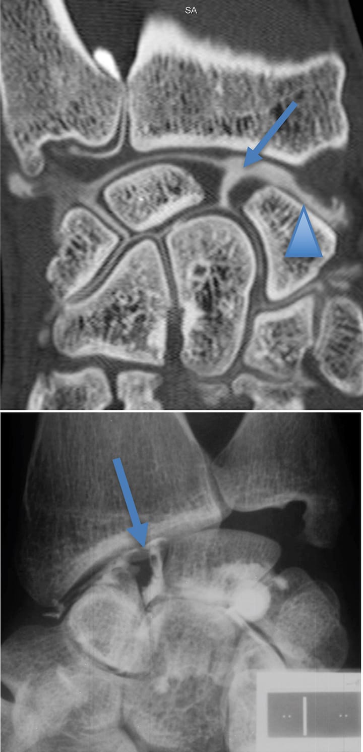 Rupture du ligament scapho-lunaire / « SLAC wrist »