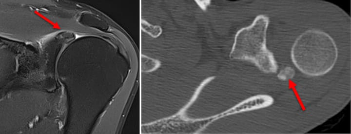 Dépôts d'hydroxyapatite sur le bourrelet glénoïdien postéro-supérieur