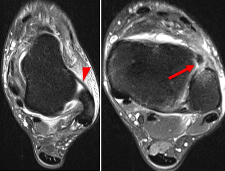 Rupture du ligament tibio-fibulaire antérieur
