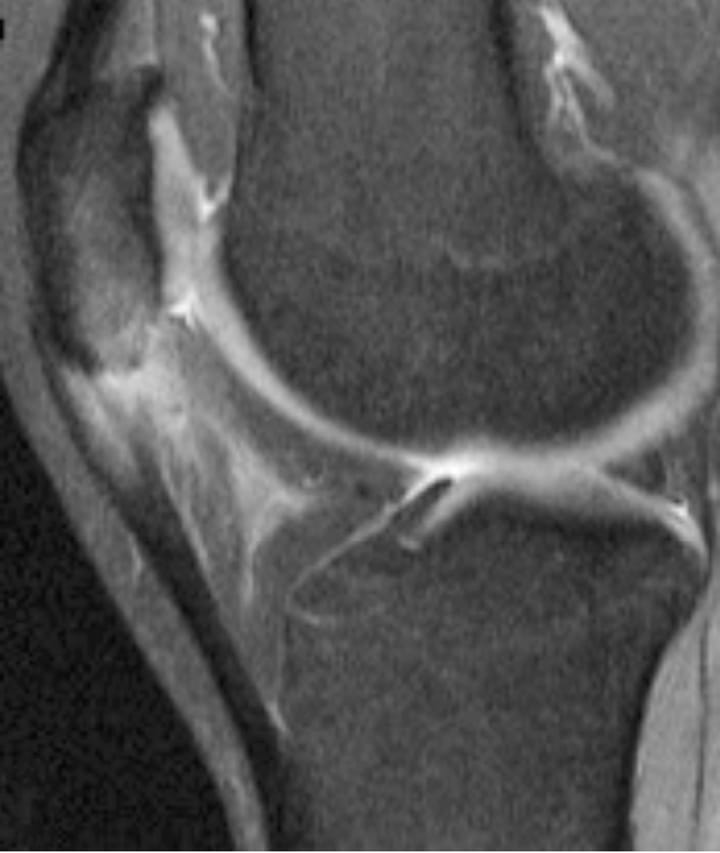 Tendinopathie patellaire proximale (jumper's knee)