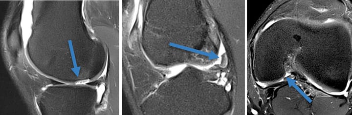 Lésion chondrale pure