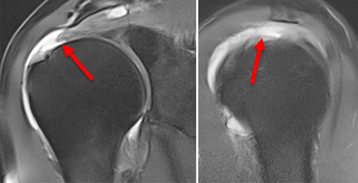 Rupture transfixiante de la coiffe des rotateurs