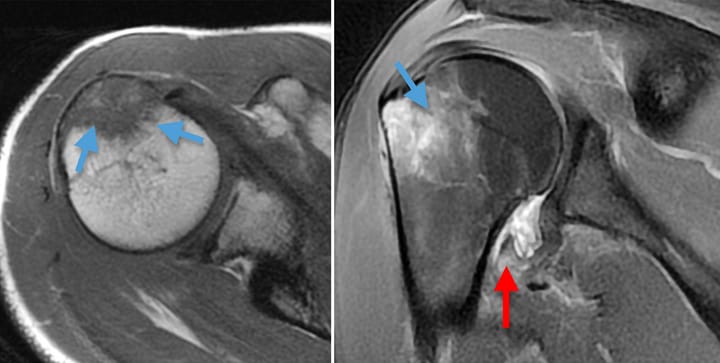 Fracture du trochiter et lésion capsulaire de type «HAGL»