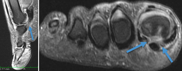 Rupture de la plaque palmaire du gros orteil « turf toe »