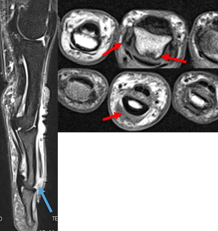 Doigt en maillet : rupture de l'extenseur sur P3