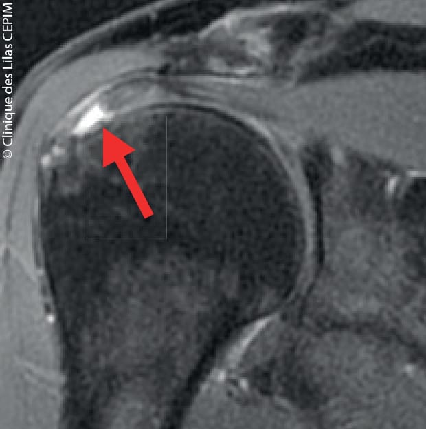 Rupture non transfixiante de la face articulaire du tendon du supra-épineux