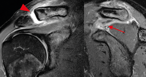 Entorse acromio-claviculaire