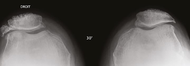 Rotule bipartite, dysplasie et arthrose fémoro-patellaire