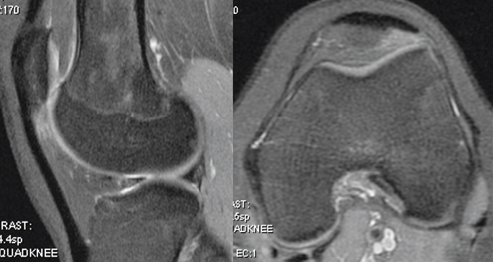 Syndrome de friction entre le ligament patellaire et le condyle latéral