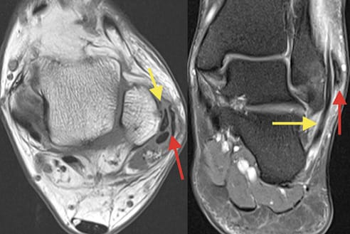 Luxation des tendons fibulaires