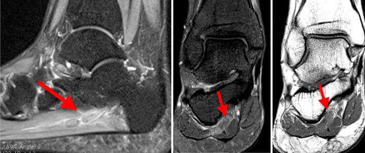 Thrombose de la veine plantaire latérale