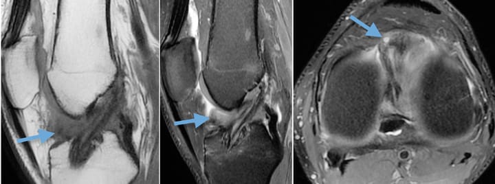Arthrofibrose ou « cyclops »