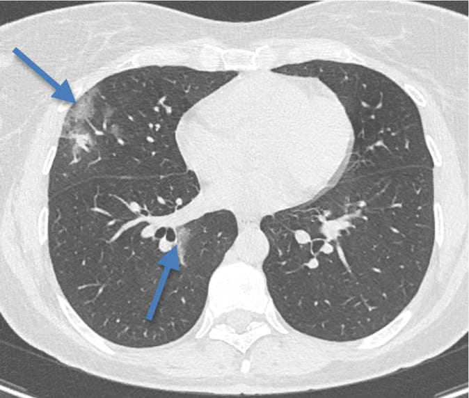 Pneumopathie en rapport avec la COVID-19